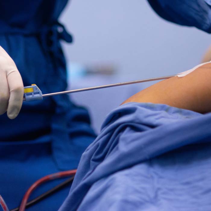 Liposuction Liposuction