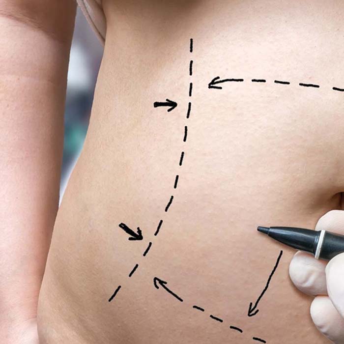 Tummy Tuck