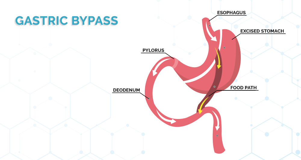Gastric-bypass