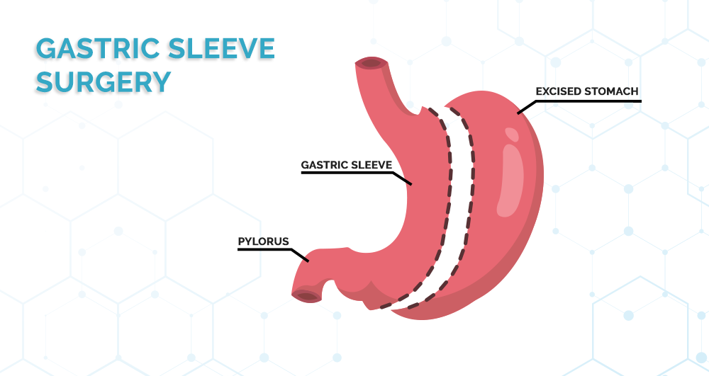 gastric-sleeve-1