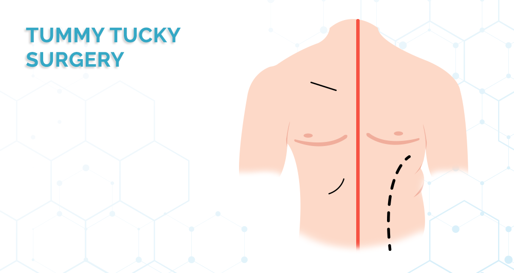 tummy-tucky-surgery